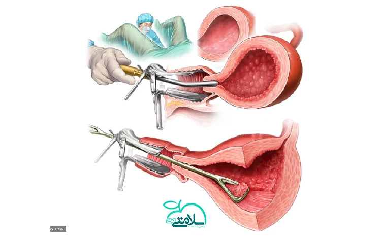 تمام آنچه که باید درباره کورتاژ بدانید